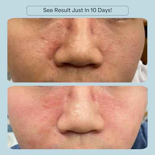 CelRevive B-Restore¢â Barrier Cream soothes, hydrates, and supports microbiome balance, restoring comfort to sensitive, dry skin. EWG Verified¢â for safety and transparency. Made in Australia