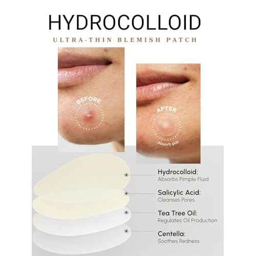 Clear Pimple Patches ? 108 Ct Hydrocolloid Acne Patches w/ Salicylic Acid & Tea Tree Oil ? Fast-Acting Zit Stickers for Face, Blemish & Spot Treatment ? Invisible, Waterproof, Gentle for All Skin
