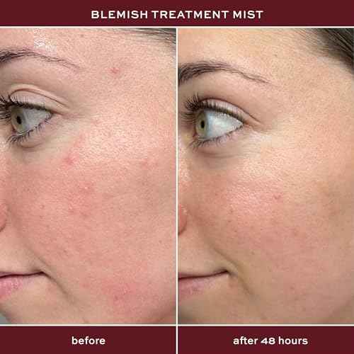 ITK Skincare 2% Salicylic Acid Spray for Face & Body Acne - Blemish-Fighting Treatment for Body Acne, Bacne, Blackheads, Pimples & Blemishes - BHA Blemish Facial Mist Post Workout - 3.3oz Spray Bottle