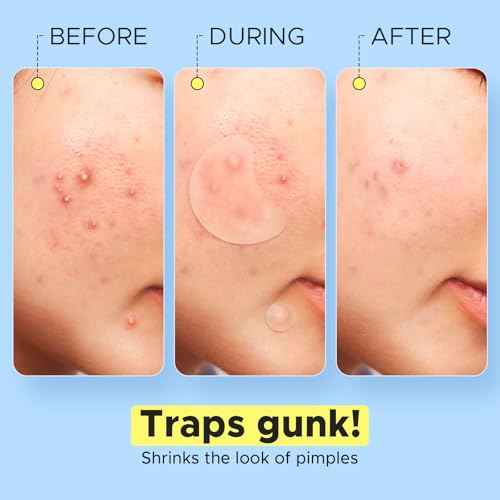 LitBear Pimple Patches for Face, Large Acne Patch, XL Hydrocolloid Bandages,Zit Stickers for Forehead, Chin, Nose, Body, Back, and Chest (5 Sizes, 228 Pimple Patches)