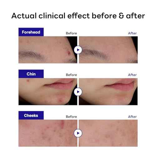 Mediheal Derma Clear Madecassoside Blemish Spot Patch (132 Counts) - Acne Spot Protection, Spot Fast Healing with Madecassoside & Niacinamide