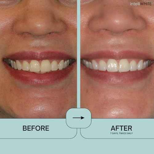 Prostrips - 12 Shades Whiter Teeth - 28 Enamel Safe REMINERALIZING Gentle Strips ? 97% no Sensitivity