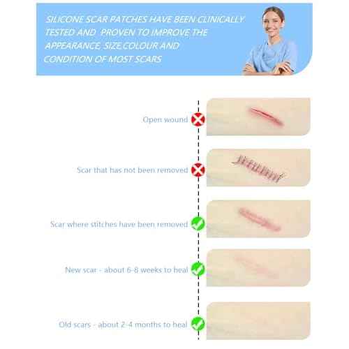 Silicone Scar Sheets, Silicone Scar Tape, 1.6" x 120" Medical Grade Scar Tape Removal Sheets for Surgical, C-Section, Burn Scars (2 Rolls-3M)