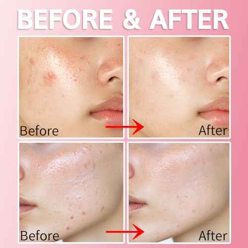 Purederm Blemish Spot Treatment Gel with Salicylic Acid 2%, Soothing Acne Care for Irritated Skin, Day & Night Use, 20ml