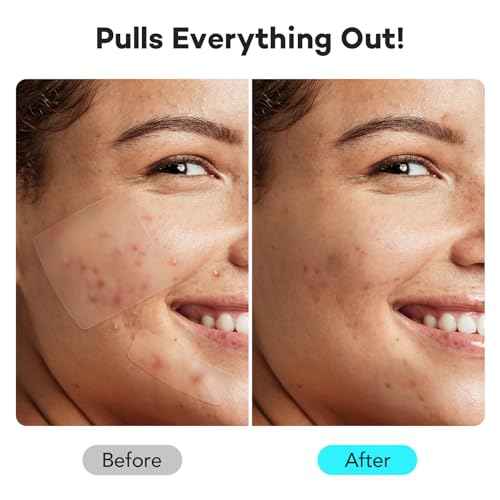 LitBear Large Pimple Patches for Face (6 Sizes 118 Pcs), Big Hydrocolloid Acne Patches, XL Hydrocolloid Bandages for Body, Cheek, Forehead, Chin, Full Face, Back, Nose
