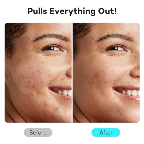 LitBear Large Pimple Patches for Face (6 Sizes 401 Counts), Big Hydrocolloid Acne Patches, XL Hydrocolloid Bandages for Body, Cheek, Forehead, Chin, Full Face, Back, Nose