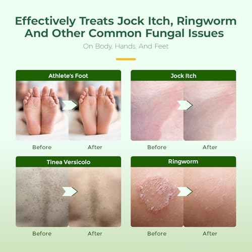 Inlifay Antifungal Soap with Tea Tree Oil: Antifungal Bar Soothing Care & Fast Itch Relief for Ringworm Jock Itch Tinea Versicolor Athlete's Foot (1, Green)