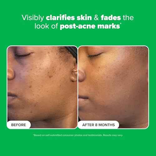 Paula's Choice BOOST 10% Azelaic Acid Booster Cream Gel Face Serum with Salicylic Acid, Oil-Free Skin Brightening Serum for Face, Fragrance-Free