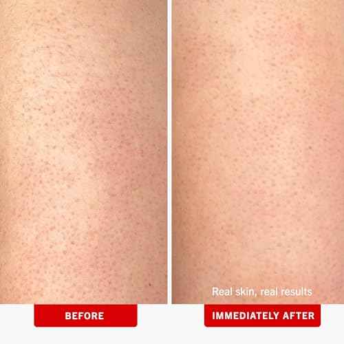 First Aid Beauty - KP Bump Eraser Body Scrub with 10% AHA, Keratosis Pilaris Skin Exfoliater with Glycolic and Lactic acids, Helps Reduce Chicken Skin Bumps, Safe for Sensitive Skin, 8 oz, 2ct