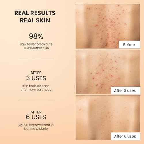 Body Acne Treatment Scrub: Helps Reduce Body Breakouts on Back, Chest, Butt & Thighs - Back Acne Treatment for Men, Women & Teens - Butt Acne Wash with Natural Actives for Smooth Skin