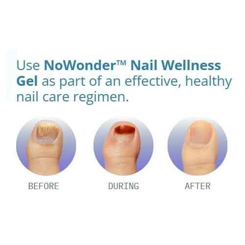 NoWonder Nail Wellness Gel | Nitric Oxide Creating Nail Renewal Solution | Supports Clearer, Healthier Nails | Non-Prescription, Safe & Easy-to-use, Nail Care, with Visible Results