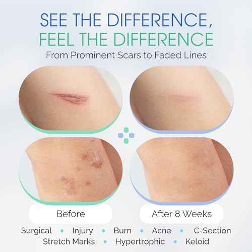100% Silicone Scar Gel Cream Serum ? Ultra-Soft Brush Applicator for Gentle Scar Therapy After Cosmetic Procedures, Facial Peels, Surgical, Acne, Burn & Keloid Scars ? Hypoallergenic & Fragrance Free