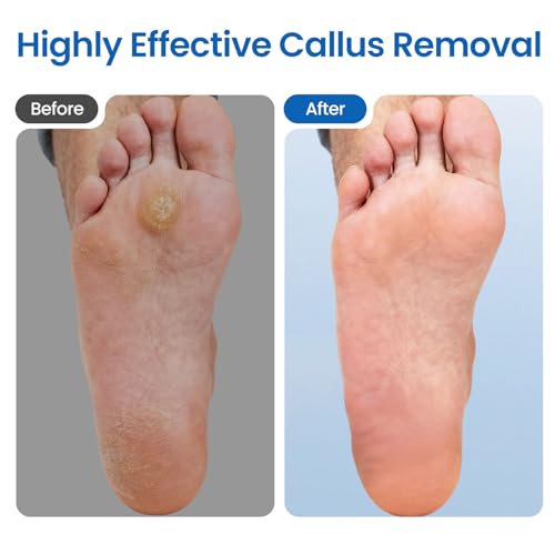 Electric Foot Callus Remover-60pcs Replacement Sandpaper Discs, 1200RPM Speed Adjustment, Metal Body, Callus & Dead Skin Removal