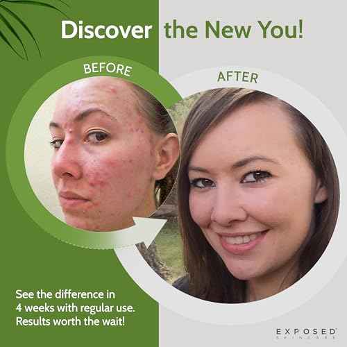 Exposed Skin Care, Basic Acne Treatment Kit with 2.5% Salicylic Acid and 3.5% Benzoyl Peroxide to Clear Up Teen, Adult, Hormonal and Cystic Acne ? Natural, Non-toxic and Cruelty Free