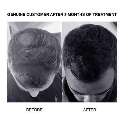 PATRICKS | SH PLUS Ultra Thickening Shampoo for Hair Loss in Men | DHT Blocker | Includes Castor Oil & Other Powerful Ingredients to Support Hair Growth | For Moderate to Advanced Hair Loss | 200mL