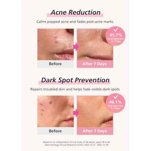 Easyderm Real Calming Patch Pimple Patches, Niacinamide, Hyaluronic Acid, EGF, K-Beauty Skincare | 6 Patches per Pack, 4 Packs (24 Total) Micro Point length : 285¥ìm