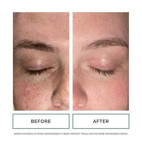Replenix Pore Minimizing Face Serum with Medical-Grade Niacinamide, Lactic & Salicylic Acids, Dermatologist-Recommended for Large Pores & Uneven Skin (1 fl. oz)