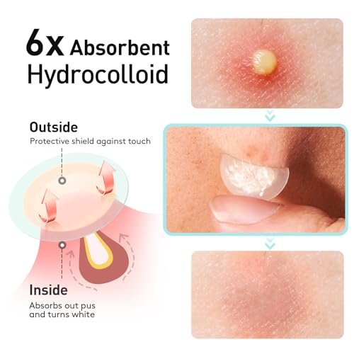 TKTK Pimple Patches, 12mm Invisible Acne Patches for Face with Salicylic Acid, 0.01cm Extra Thin Outer Edge, Hydrocolloid Zit Patch for Pustule, Whitehead, Cystic Acne Spot, 96 Count