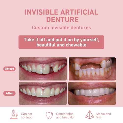 Custom Partial Dentures ? Personalized Removable Denture Set for Missing Teeth | 1?6 Tooth Replacement with Storage Case | Natural Look & Comfortable Fit (1 Tooth)