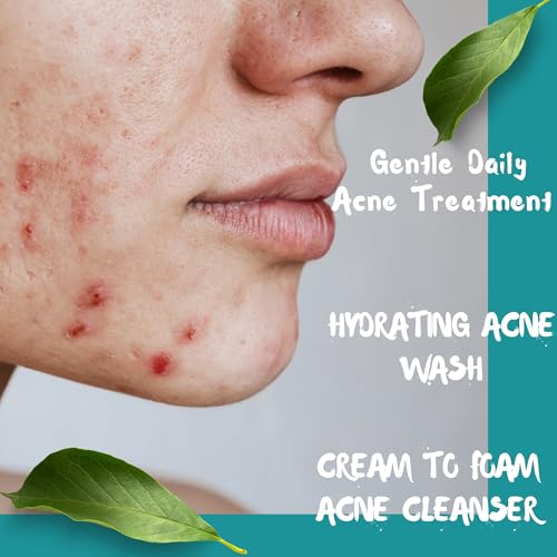 Creamy Acne Foaming Wash 4% Benzoyl Peroxide Face Wash With Hyaluronic Acid & Ceramides Gentle Daily Acne Skin Care 6.76 Fl Oz