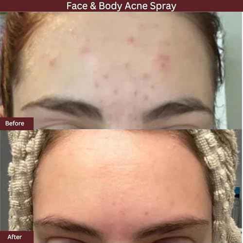 ITK Skincare 2% Salicylic Acid Spray for Face & Body Acne - Blemish-Fighting Treatment for Body Acne, Bacne, Blackheads, Pimples & Blemishes - BHA Blemish Facial Mist Post Workout - 3.3oz Spray Bottle