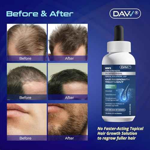 Minoxidil for Men Hair Growth Serum: Minoxidil 5 Percent - Hair Regrowth for Men - Minoxidil for Beard Growth - Hair Loss Treatments - Minoxidil 5% - Faster Thicker Stronger Hair Growth - 60ml