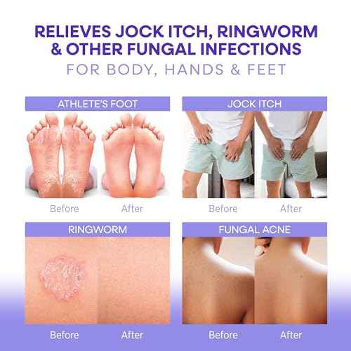 Hermon Antifungal Soap with Tea Tree Oil: Antifungal Bar Soothing Care & Relief of Itchy for Ringworm Jock Itch Tinea Versicolor Athletes Foot - Body & Face Wash - Lavender