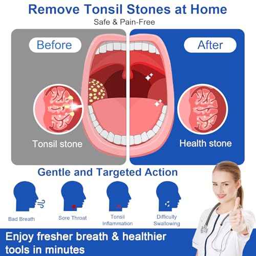 Tonsil Stone Vacuum Remover with LED Light Upgraded Electronic Oral Care Cleaning Tool Set 6 Suction Levels for Fresh Breath & Comfortable Use (White)