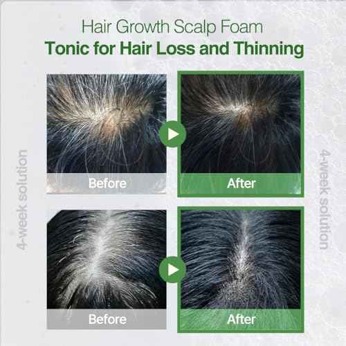 ROOTONIX Rosemary Scalp Tonic for Thinning Hair, Leave-In Treatment, K-Beauty Hair Growth Foam with Biotin, Caffeine (3.38oz /100 ml)