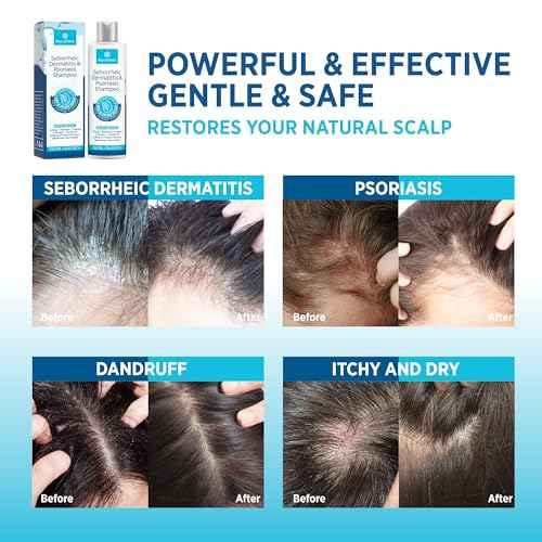 Roycederm Seborrheic Dermatitis & Psoriasis Shampoo and Conditioner Set - Effective Scalp Treatment for Folliculitis, Psoriasis, Dandruff, Dry Itchy Scalp - Soothing, Moisturizing Herbal Formula