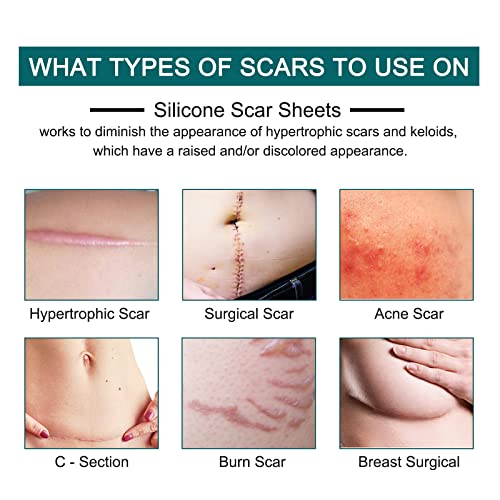 Silicone Scar Sheets (1.6¡± x 120¡± Roll-3M), Silicone Scar Tape Roll, Scar Silicone Strips, Reusable, Professional Scar Removal Sheets for C-Section, Surgery, Burn, Keloid, Acne et