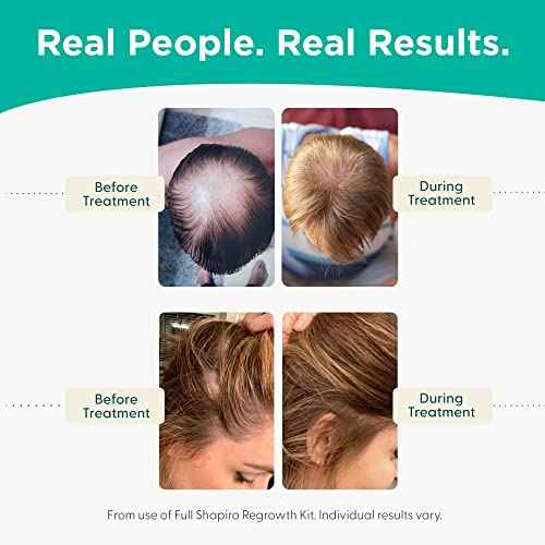 Shapiro MD Hair Growth Experts Hair Loss Conditioner, DHT Fighting Vegan Formula for Thinning Hair Developed by Dermatologists, Experience Healthier and Thicker Looking Hair - 4 Month Supply