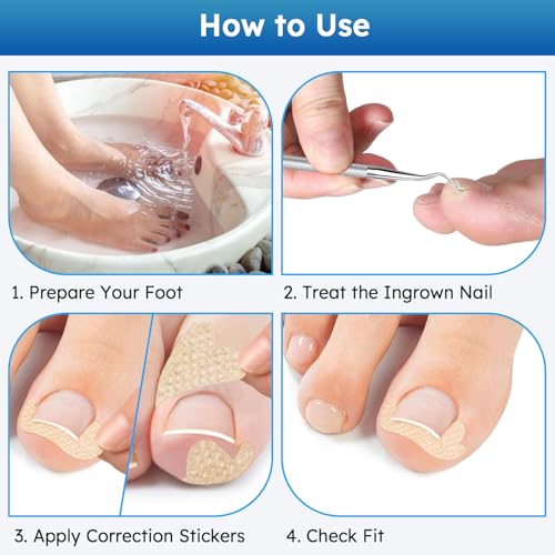 Ingrown Toenail Treatment, No Glue Breathable Curved Toenail Corrector£¬Ingrown Toenail Corrector Strips with File and Lifter, Professional Nail Correction Stickers 60Pcs