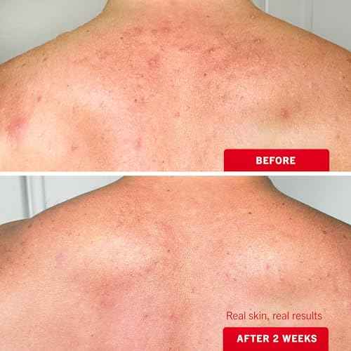 First Aid Beauty Body Acne Spray - Maximum Strength Body Acne Treatment With 360-Degree Sprayer - 2% Salicylic Acid Formula, (3.0 oz)
