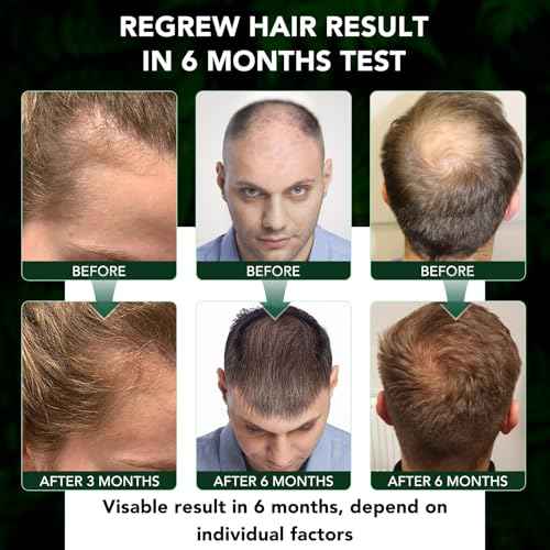 Minoxidil Hair Growth Spray for Men & Women, 5% Minoxidil Topical Solution Hair and Beard Growth Serum, Advanced Hair Regrowth Oil Treatment for Hair Loss, Thinning, Hair Regrowth & Thicker 2.02 fl.oz