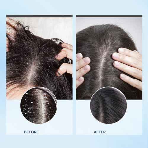 Bablabear Scalp Exfoliator Scrub,Itchy Scalp Treatment for Dandruff, No Sulfate Hair Scrub To Soothe a Dry, Flaky,Scalp,Removes Buildup,Clarifying Shampoo.