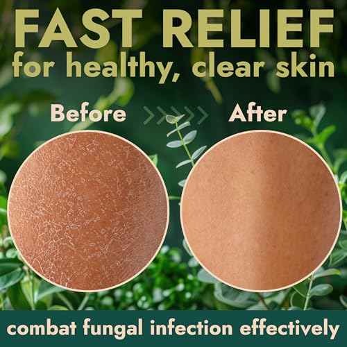 Antibacterial Body Wash | Antifungal Soap for Men & Women | Kills 99.9% of Germs & Bacteria | Helps with Back Acne, Body Odor, Jock Itch & Skin Irritation | Manuka Honey & Charcoal, 16 fl oz