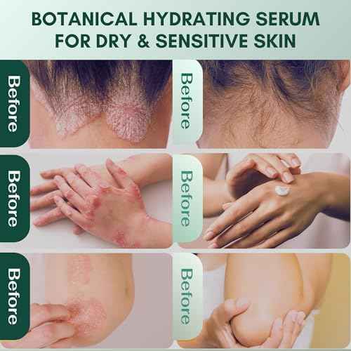 ABERA Alan Silver Serum ? Gentle Botanical Formula for Dry, Flaky Scalp and Sensitive Skin ? Enhances Skin Comfort and Moisture Balance ? Lightweight, Non-Greasy Texture ? Bonus Gift Included