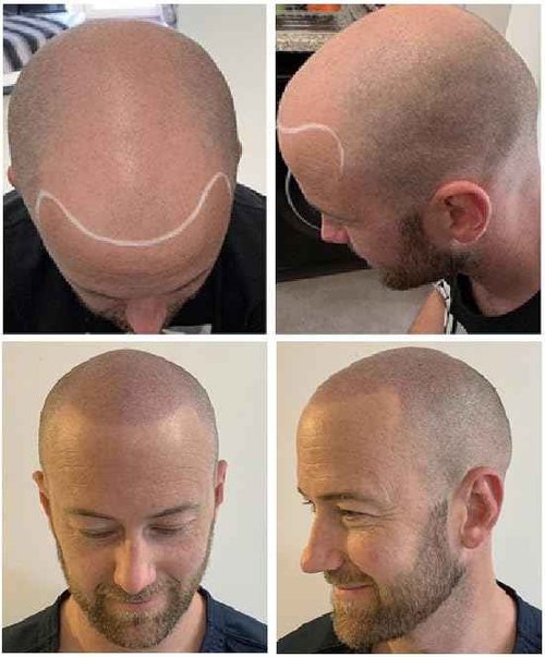 Nuva Follifill SMP Pigment & Cartridge Needle Kit – Deepest Scalp Micropigmentation Ink with Superior Retention, 15ml Bottle for 50+ Treatments, 20 Sterilized Needles, Mixer, Brown