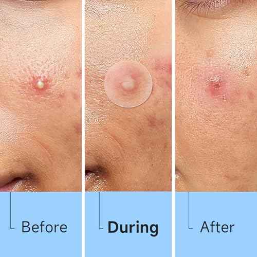 Acne Pimple Patch(840 Counts 4 Sizes), Zit Stickers for Face, Hydrocolloid Spot Stickers, Clear Acne Dots for Covering Zits, Blemishes, and Breakouts