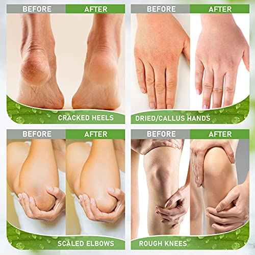 Urea Cream 42% with 2% Salicylic Acid, Callus and Dead Skin Remover, Deeply Moisturize, Repair Dry, Cracked, Rough Skin of Heel, Elbow and Knee, Effective Urea Foot Cream(7oz)