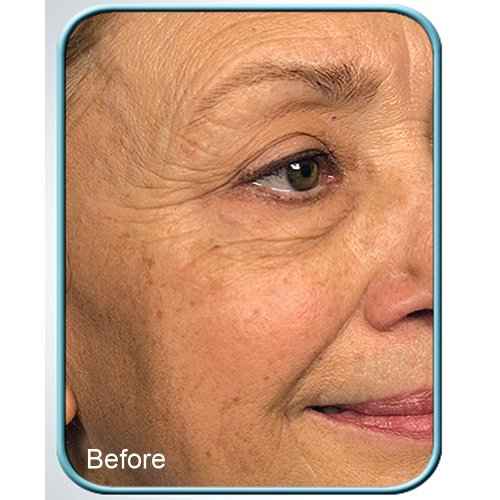Stem Cell Therapy 3-pack