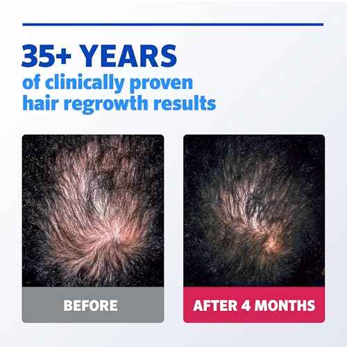 Men¡¯s Rogaine Extra Strength 5% Minoxidil, Topical Solution for Thinning & Hair Loss, Clinically Proven FDA Approved Minoxidil for Men Treatment, Regrow Fuller Hair, 3 Month Supply, 3 Bottles