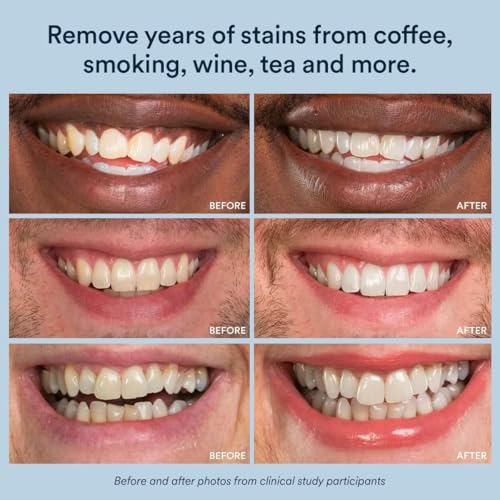 Auraglow Extra Strength Teeth Whitening Strips, Strong Whitening Strips, 14 Whitening Treatments, 11% Hydrogen Peroxide with Nano Hydroxyapatite to Reduce Sensitivity & Protect Enamel, 28 Strips, Mint