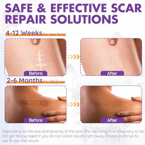 Silicone Scar Sheets, Silicone Scar Tape(1.6"x 118" Roll-3M), Reusable Professional Scar Silicone Strips, Soft Silicone Scar Sheets for Surgical Scars,Keloid,Acne Scars,Burn Scar,C-Section