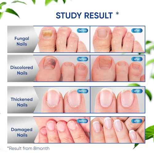Fungus Treatment for Toenails, Toe Nail Fungus Treatment Extra Strength, Toenail Fungus Treatment, Fast Acting - 2 Packs, Black