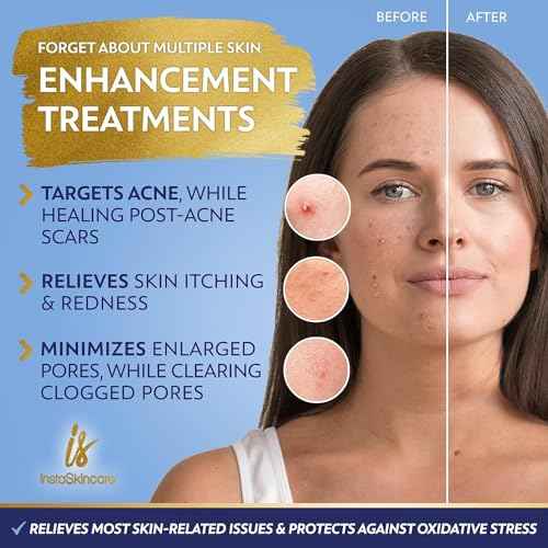 Niacinamide Serum 8Oz for Face 10% with Zinc 1% Vitamin B3 Brightening Serum for Tone, Texture