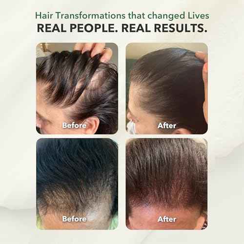 Ayurvedic Growth Accelerator Hair Serum for Hair Growth | Serum for Hair Growth | Scalp Serum for Hair | Hair Growth Products, 100ml