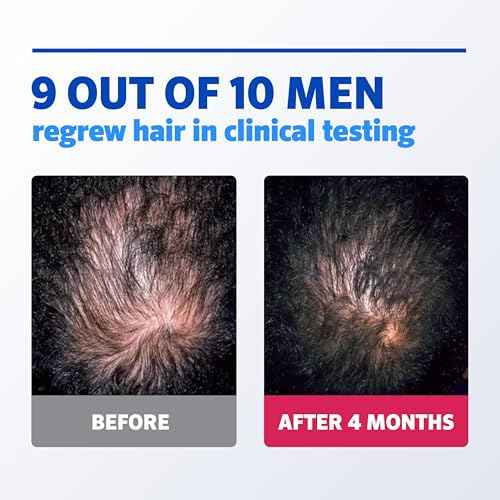 Men¡¯s Rogaine 5% Minoxidil for Men Foam, Clinically Proven Regrowth for Thinning Hair, Topical Hair Loss Treatment, Unscented Topical Aerosol, Results in 8?16 Weeks, 3-Month Supply, 3 x 2.11 oz