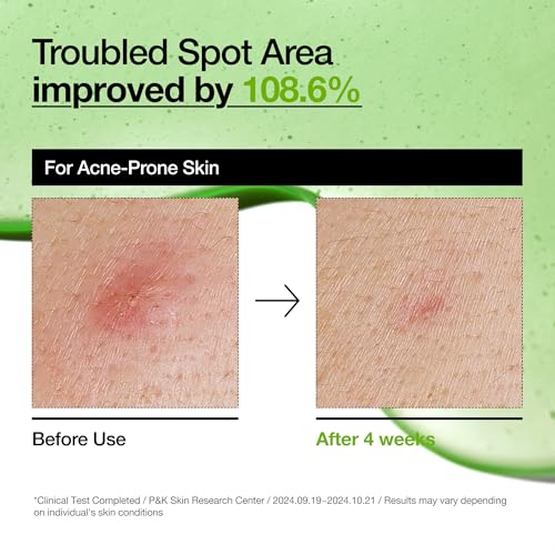 Anua Azelaic Acid 10 Hyaluron Redness Soothing Serum, Facial Serum for Troubled & Sensitive Skin, Breakouts, Hyaluronic Acid, Niacinamide, Spot Care, Natural Color, Korean Skincare (30ml/ 1.01 fl oz.)